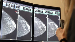 Áttörés a mellrákszűrésben? A DeepHealth új platformja már most átírja a radiológia jövőjét kép