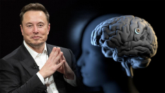 Megkapta az első ember Elon Musk agyba ültethető chipjét kép