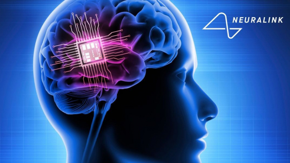 Gondolatokat alakít beszéddé a Neuralink agyimplantátuma kép